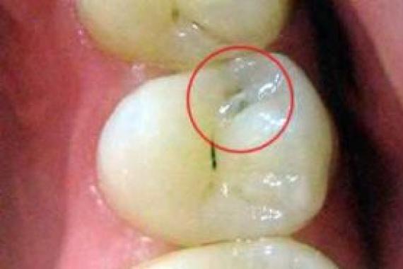 Кариес под пломбой — почему лечение зубов может быть неэффективным